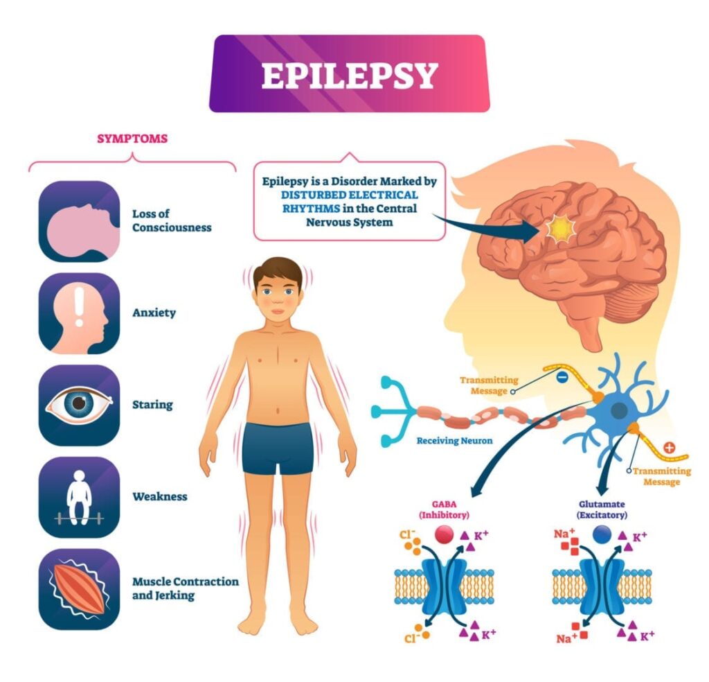 The Benefits of a Keto Diet for Epilepsy